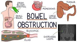 Bowel Obstruction: Understanding Causes, Symptoms, and Management